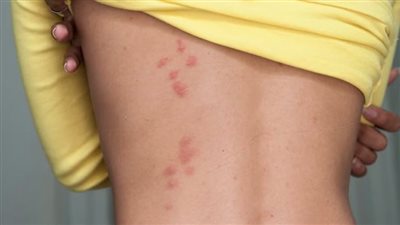 كيف تتخلص من حشرة بق الفراش وكيف تتجنبها؟