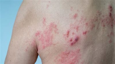 ما هو مرض القوباء المنطقية وما هي أعراضه وأسباب الإصابة به؟