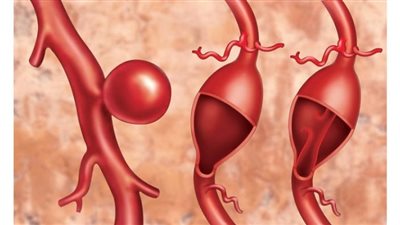 أم الدم الدماغية.. مرض خطير يهدد شرايين المخ وهذه أعراضه وطرق علاجه