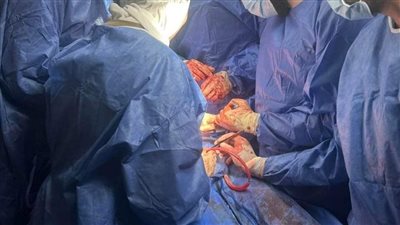 تفاصيل نجاح مستشفى سرس الليان في إجراء عملية جراحية خطيرة