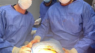 لأول مرة.. مستشفى شبين الكوم تنجح في تثبيت كسر فقرات عن طريق الجلد