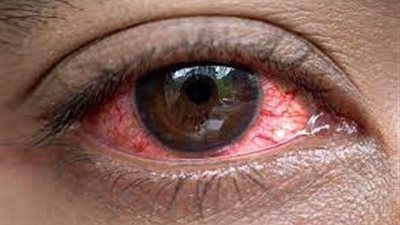 أبرزها وقف التدخين.. كيف تحافظ على نظرك عند الإصابة بجفاف العين؟ 