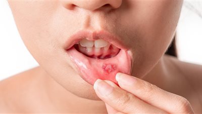 أبرزها تنظيف الأسنان.. نصائح مهمة للتعامل مع قرح الفم