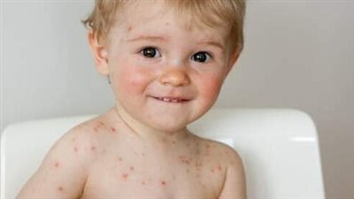 وزارة التعليم تصدر تعليمات عاجلة بعد انتشار الجدري المائى بين طلاب المدارس