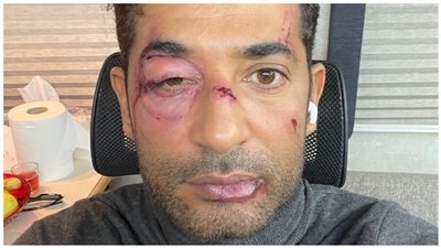 بكدمات وجروح في وشه.. عمرو سعد في ظهور غريب (صورة)