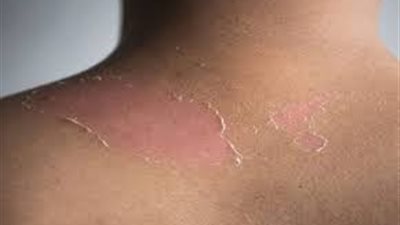 أبرزها تناول الأغذية الصحية.. نصائح لتجنب جفاف الجلد في الشتاء