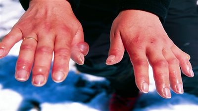 عضة البرد.. أسبابها وأعراضها وطرق الوقاية 