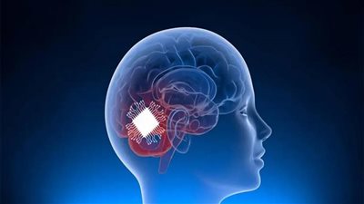 تمكنك من التحكم في هاتفك.. قصة نجاح زرع شريحة دماغية في أول إنسان