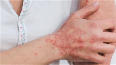 ما هو مرض مورجيلونس الغامض؟ وكيف ينتشر بين البشر؟