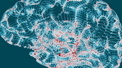 ما هي السكتة الدماغية.. وكيف تتجنبها؟