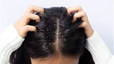 أمراض تسبب في ظهور قشرة الشعر بكثرة في فصل الشتاء.. تعرف عليها