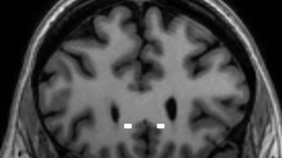 هل يمكن علاج الاكتئاب بجهاز تنظيم ضربات القلب؟