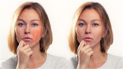 ما هو مرض الخدود الوردية؟ وكيف يمكن الوقاية منه؟