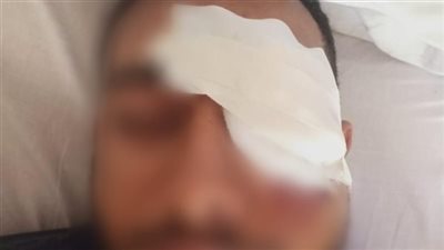 تقرير طبى يكشف السبب الحقيقي وراء «فقأ» عين سائق توك توك بالجيزة