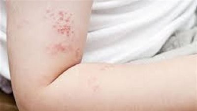 ‎الأكلات الممنوعة لمرضى الحزام الناري