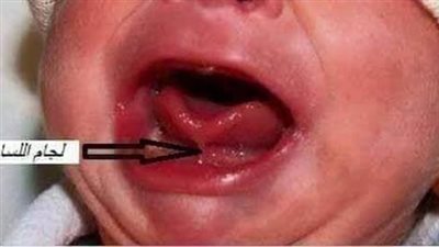 اللسان المربوط عند الرضع.. أعراضه وطرق علاجه 