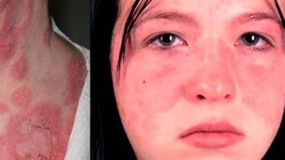 ما هو مرض الذئبة؟ وما أعراضه؟