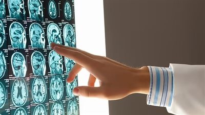 علماء يطورون اختبارًا يكشف عن مرض الخرف قبل 9 سنوات من الإصابة