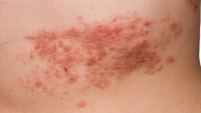  نصائح للتعامل مع  فيروس الهربس تقدمها هيئة الدواء