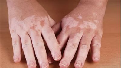 ما هو البهاق.. وهل يمكن أن يصيب أي منطقة في الجلد؟