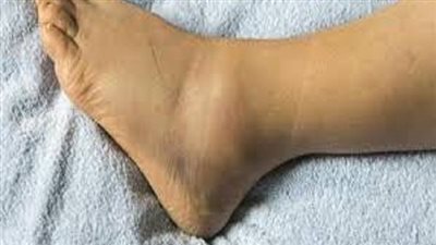 تعرف علي أسباب تورم القدمين وكيفية الوقاية منه