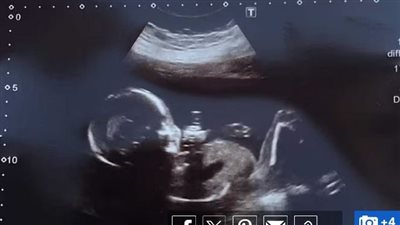 ما علاقة مادة ثنائي الفينول الكيميائية بمرض التوحد؟