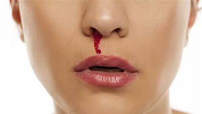 نزيف الأنف: مؤشر كبير على وجود مشكلة طبية خطيرة