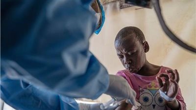 لأول مرة.. الجابون تعلن اكتشاف أول حالة إصابة بجدري القرود 