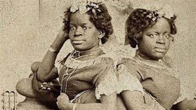 قصة توأم كارولينا الملتصق.. عاشا في العبودية ونهايتهما مآساوية