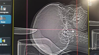 نجاح جراحة دقيقة لإيقاف نزيف المخ لطفلة بمستشفى الكرنك في الأقصر 