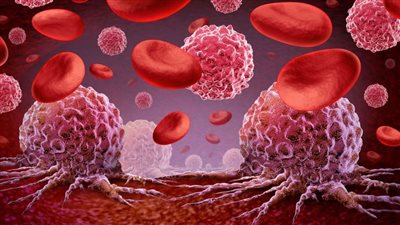 ما هو سرطان الدم وما أعراضه الشائعة؟