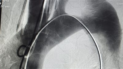 أطباء الأقصر ينجحون في إنقاذ حياة عجوز تعاني من انشطار بالشريان