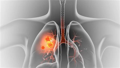 هل يمكن الإصابة بمرض سرطان الرئة حتى لو لم تكن تدخن؟