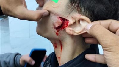 بعد الاعتداء عليه بزجاجة مكسورة فى 