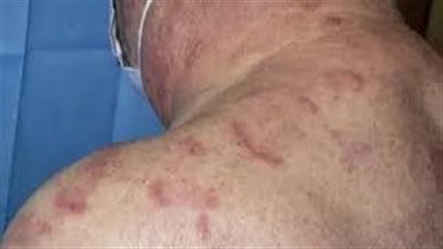 بعد إكتشافه بمريض بالقصر العيني.. تفاصيل مرض 