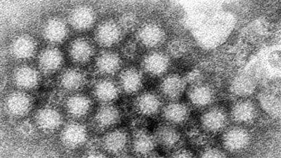 ما هو فيروس نوروفيروس؟ وما أعراضه؟ وأسبابه؟