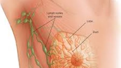 متى يكون الرنين المغناطيسي لاكتشاف أورام الثدي مطلوبا؟