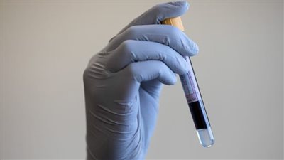بحث علمي يؤكد اختبار الدم البسيط قد يتنبأ بالإصابة بالسرطان 