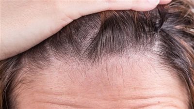 ما هي علامات تساقط الشعر المبكر وكيف تمنعه؟