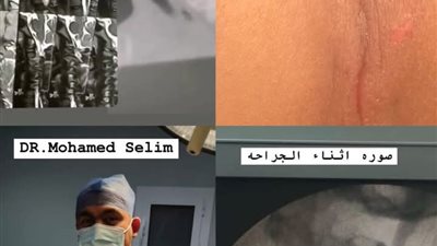 للمرة الأولى بالدقهلية.. نجاح جراحة دقيقة لإصلاح كسر بالرقبة في تمى الأمديد