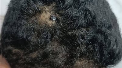 بالصور.. استخراج مسمار معدني اخترق جمجمة طفل بالفيوم