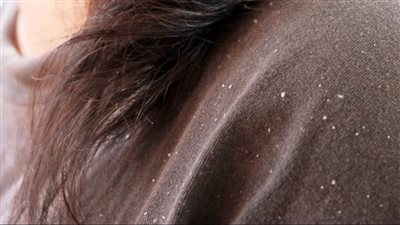 ما أسباب انتشار القشرة بكثافة في الشعر؟