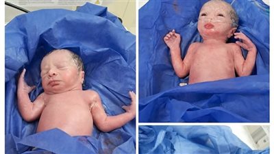 ولادة نادرة لثلاثة توائم في أحد مستشفيات المنيا