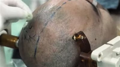 لأول مرة.. الصين تختبر شريحة دماغية للتحكم في البشر بالذكاء الاصطناعي