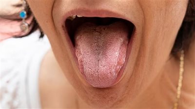 ماذا يكشف اللسان عن صحتك ؟