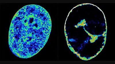في غضون 60 دقيقة فقط.. فيروس الهربس يسيطر على الحمض النووي البشري