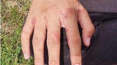 مرتادو المصايف في خطر داهم بسبب هذا الخطأ الشائع