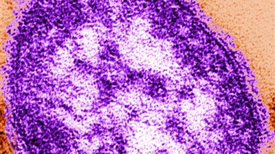 ما هو التأثير طويل المدى لعدوى الحصبة على الأطفال؟