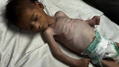  2 مليون فلسطيني بغزة يواجهون خطر الإبادة عبر التجويع.. 71 طفلًا لقوا حتفهم بسبب الجوع 