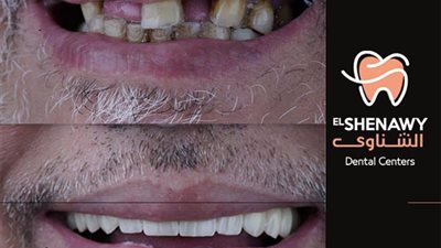 سعر زراعة الاسنان بأقل تكلفة في مصر!
